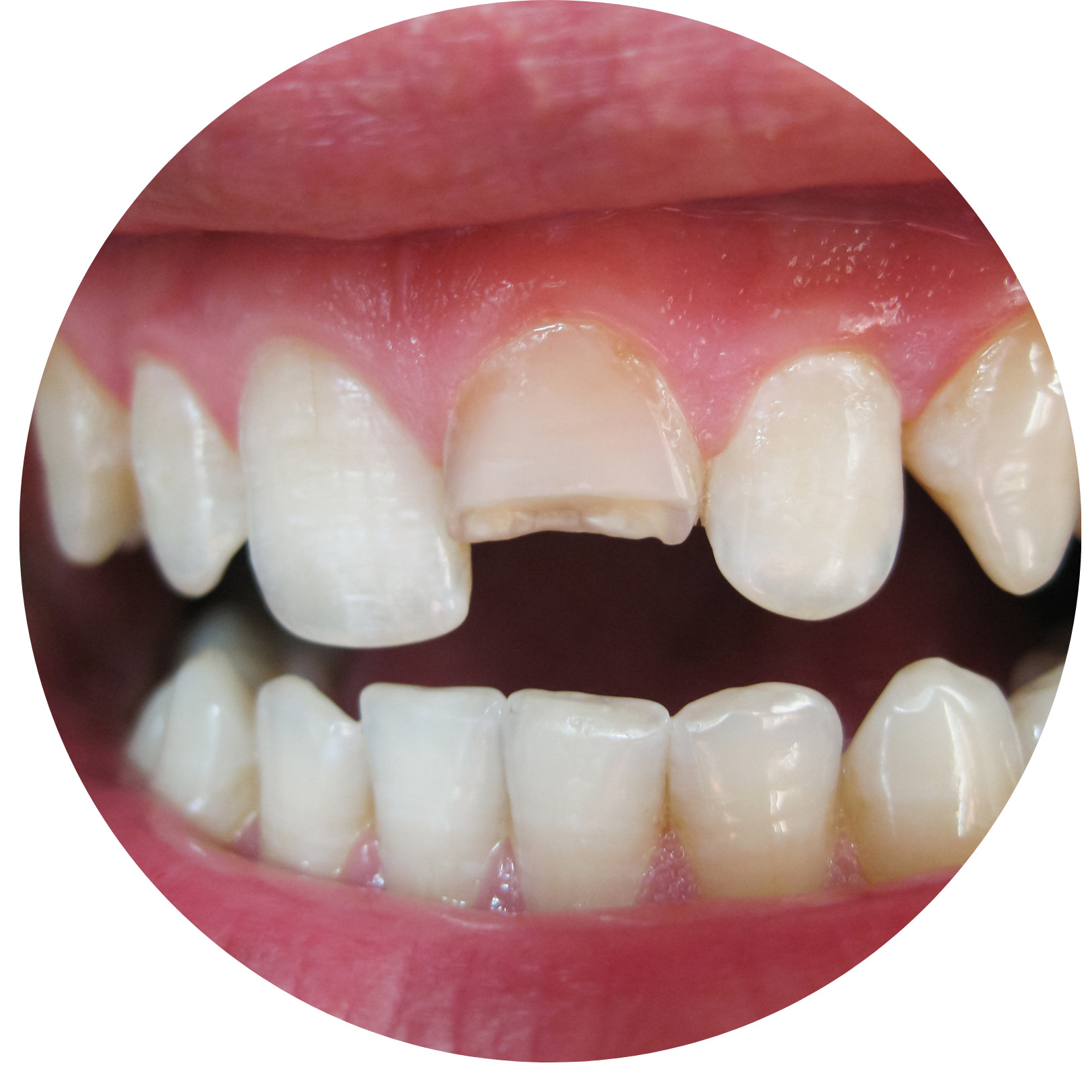 dental imlants Delhi